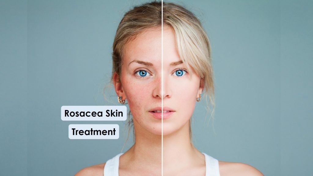 Rosacea Skin Care Tips, Causes & Natural Skin care Products
