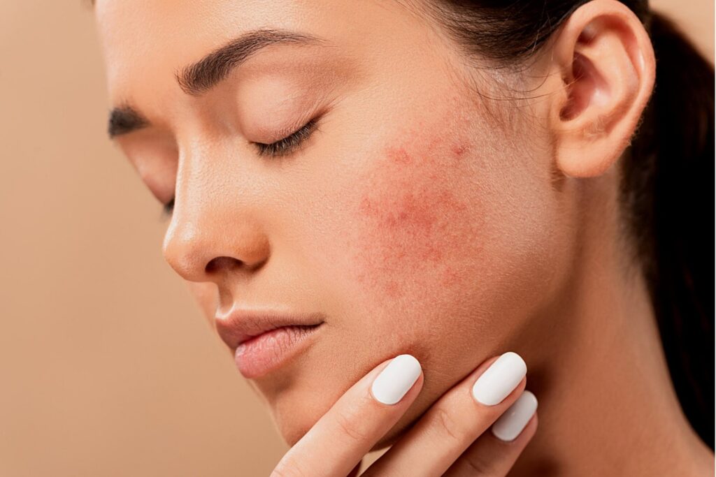 Acne issues, Get Rid of Acne During Monsoon