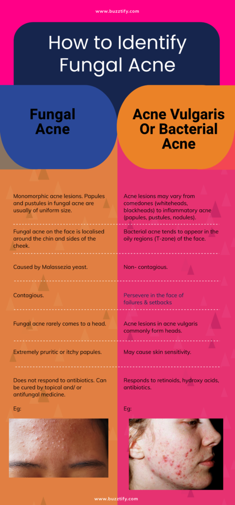 Fungal Acne on Face: Causes, Treatments, Symptoms
