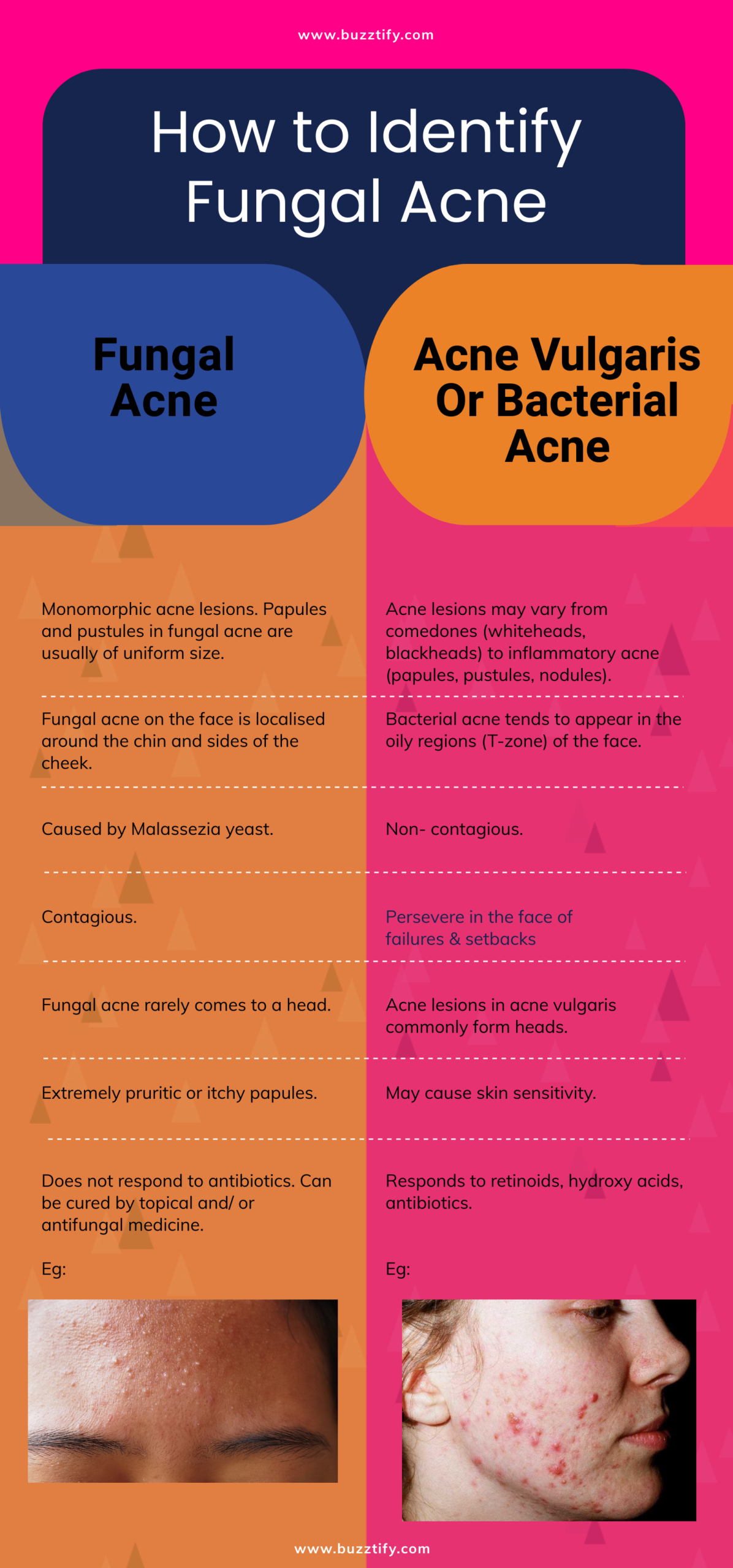 Fungal Acne On Face Or Forehead Causes Treatments Symptoms And Routine