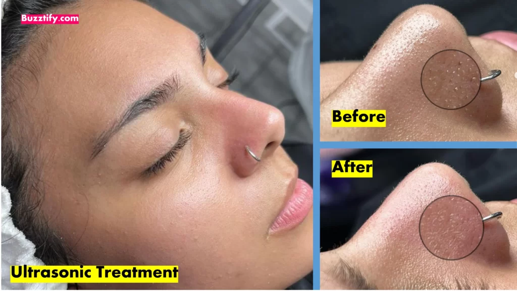 Ultrasonic treatment before after effects