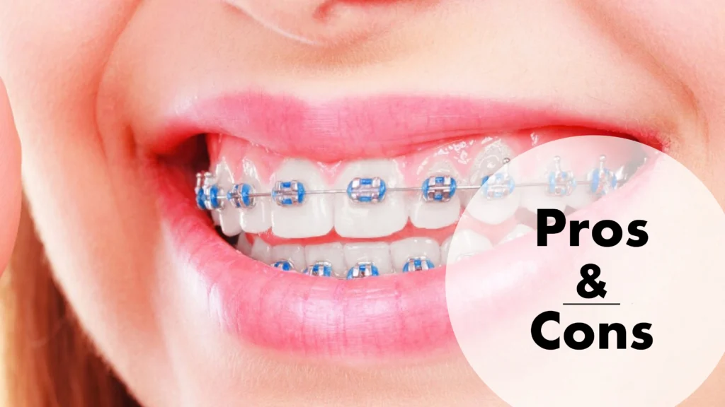 Braces Pros and Cons