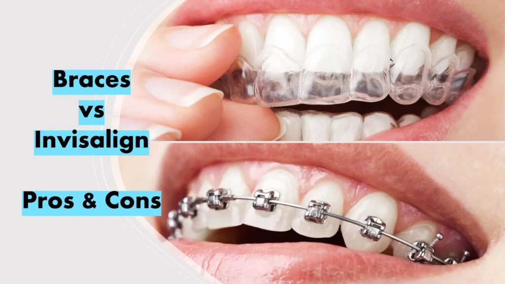 Should I Get Braces Or Invisalign? Braces vs Invisalign - Buzztify