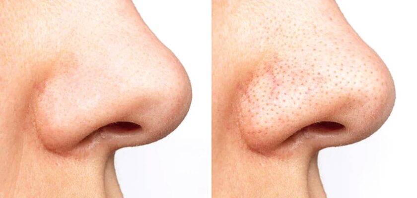 How to Clear Open Pores on Nose for Oily Skin