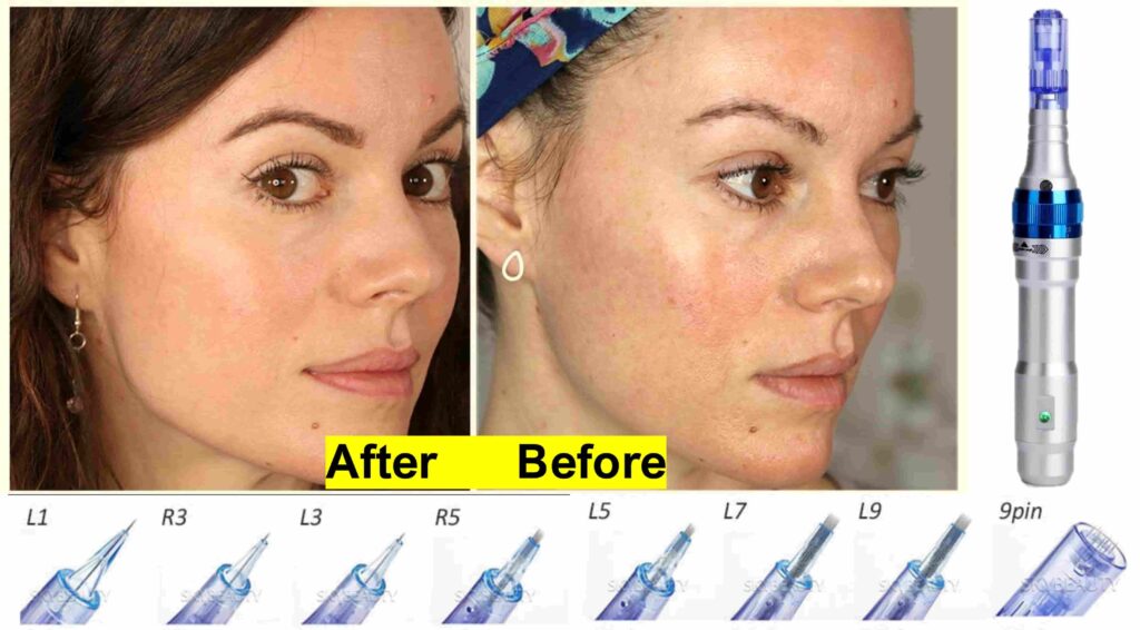 nano needling before after by Dr. pen