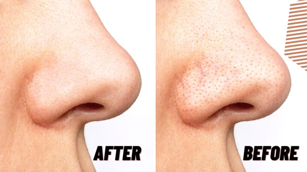 Open Pores on Nose before after