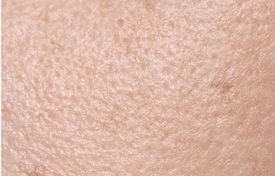 Open Pores on Skin