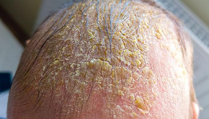 Baby Flaky Scalp (Cradle Cap) Prevention And Treatment