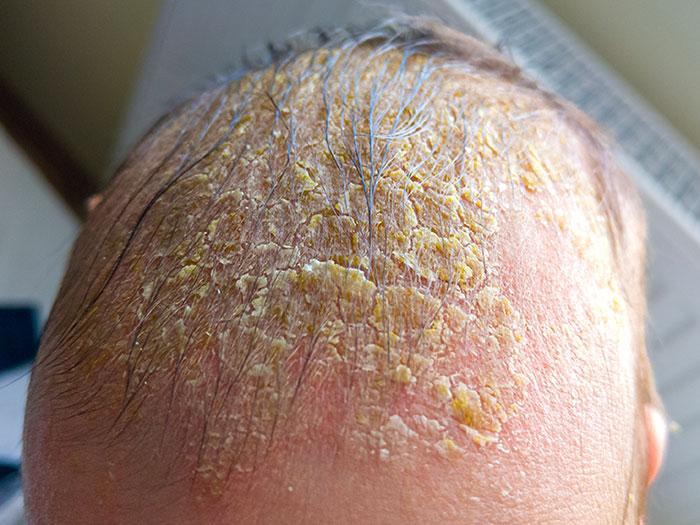 Baby Flaky Scalp (Cradle Cap) Prevention And Treatment - Buzztify